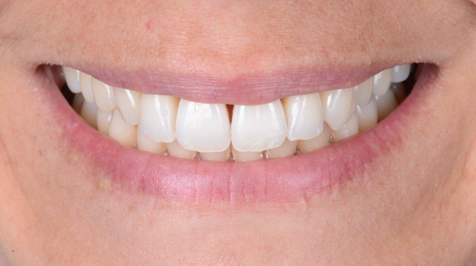 Blanchiment des dents pas cher vers Embrun en région PACA