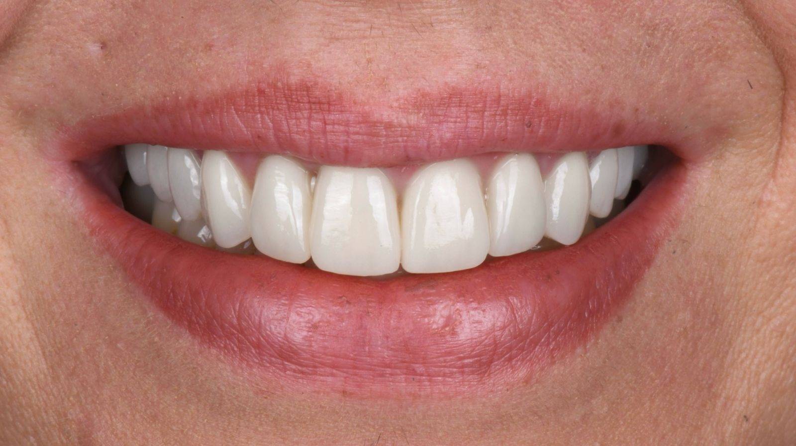 Pose d'implants dentaires pas chers vers Cassis et La Ciotat