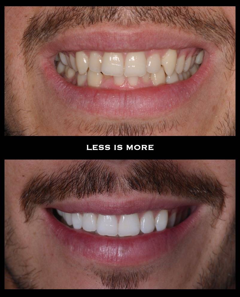 Invisalign 13008