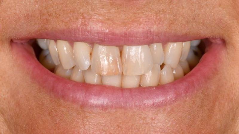 Dent jaune et dévitalisée je n'aime pas mon sourire Martigues