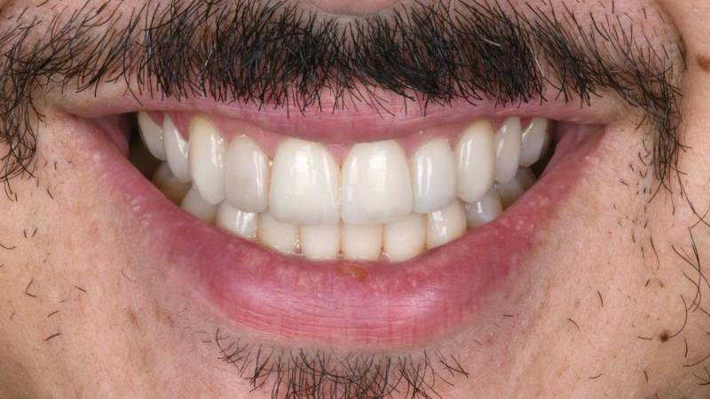 Facettes dentaires Marseille Prado 13008 Bouche du Rhônes