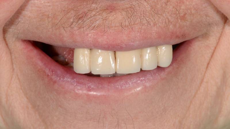 Je n'aime pas mon sourire je ne peux plus manger mes dents tombent et maladie parodontale