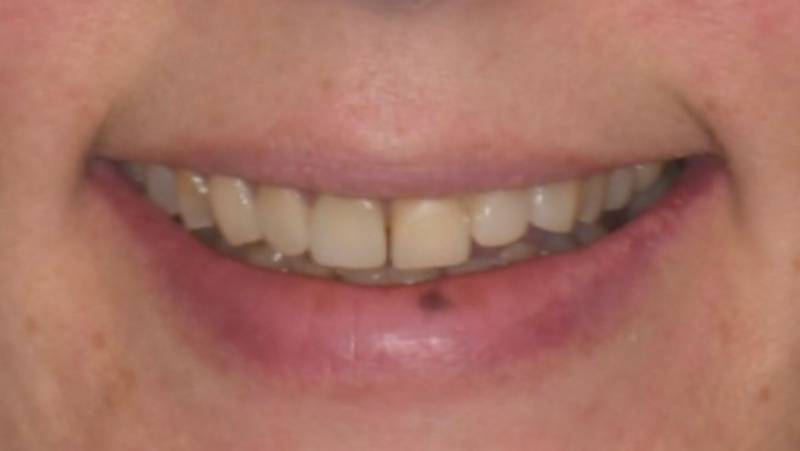 Traitement dentaire pas esthétique - je n'aime pas mon sourire - je n'aime pas mes dents jaunes