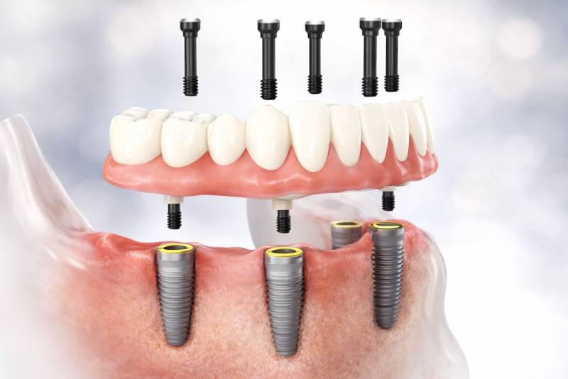 Bridge complet vissé sur implants permettant de remplacer l’ensemble des dents d’une arcade dentaire