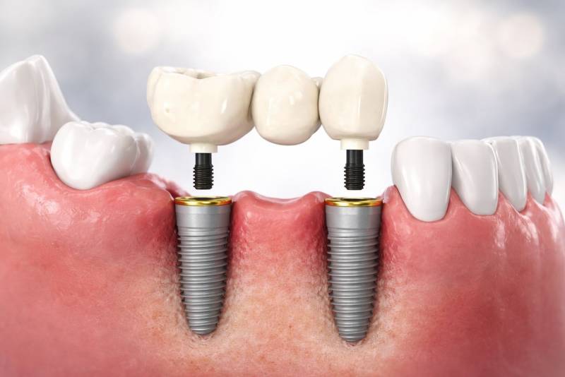 Bridge dentaire vissé sur implant permettant de remplacer plusieurs dents absentes.