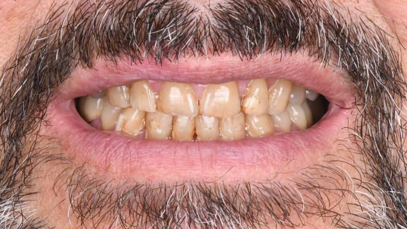 Dents jaunes bruxisme dents condamnées dents pas alignées