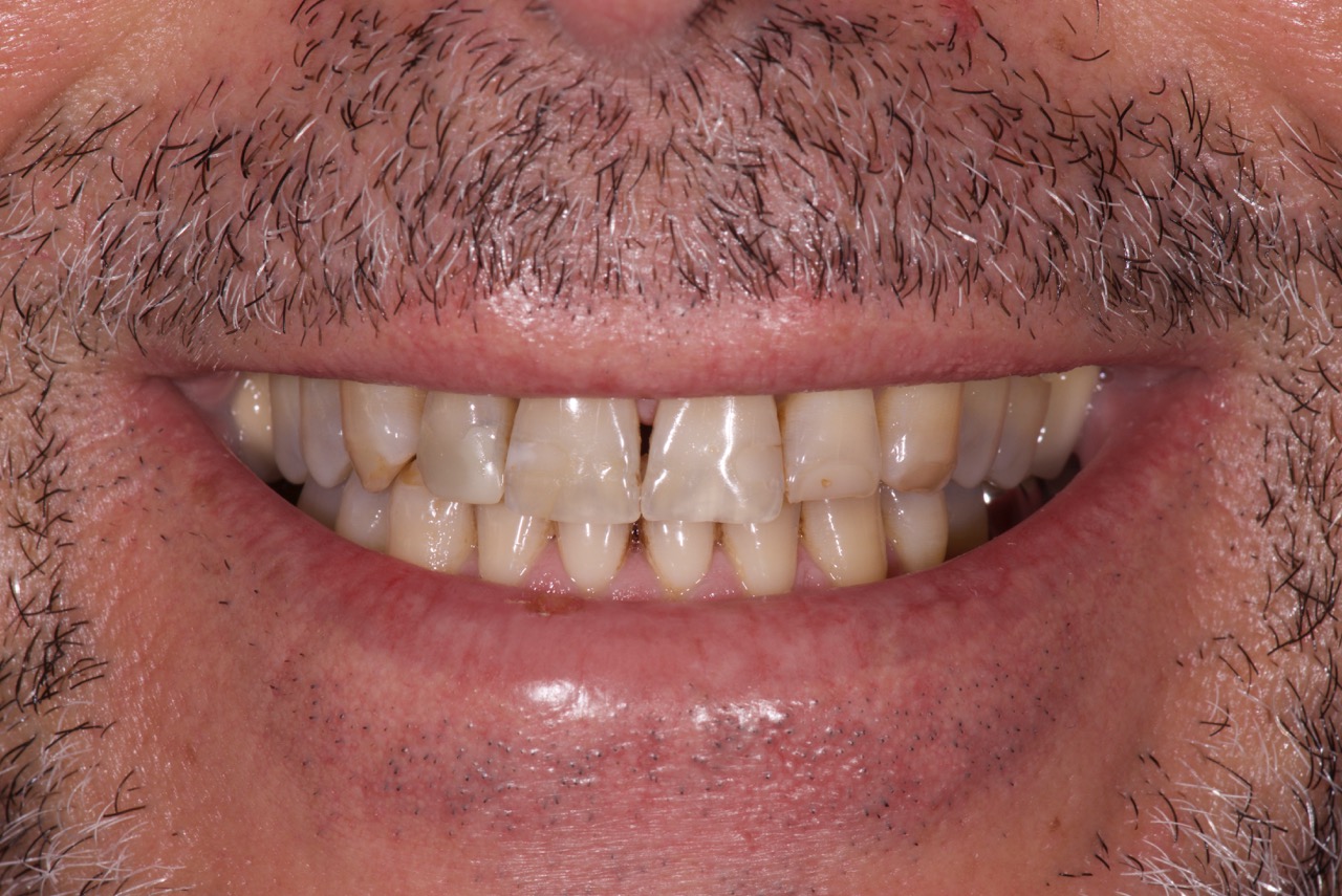 Sourire homme 50 ans avant traitement