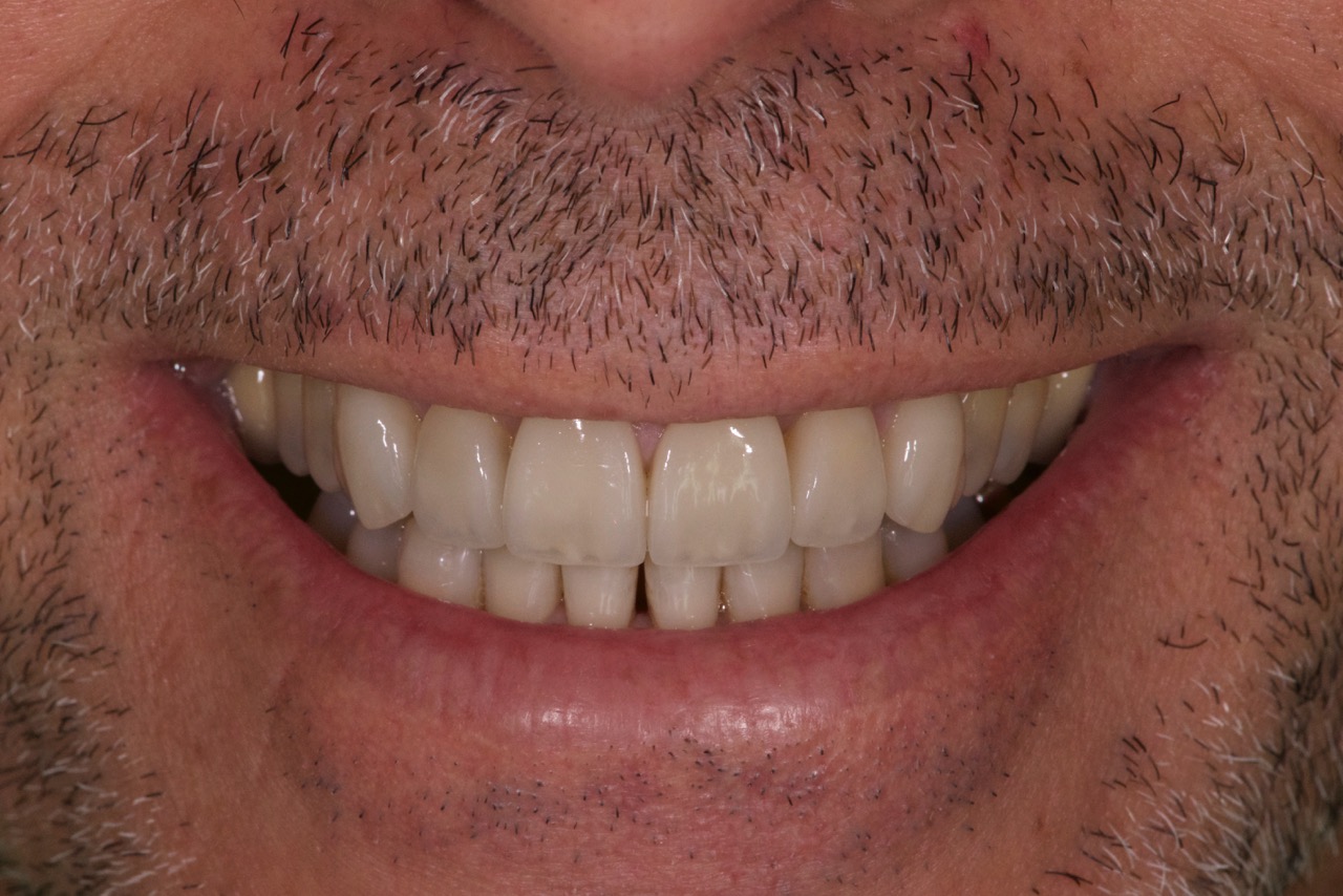 Sourire homme après traitement facette, blanchiment greffe de gencive