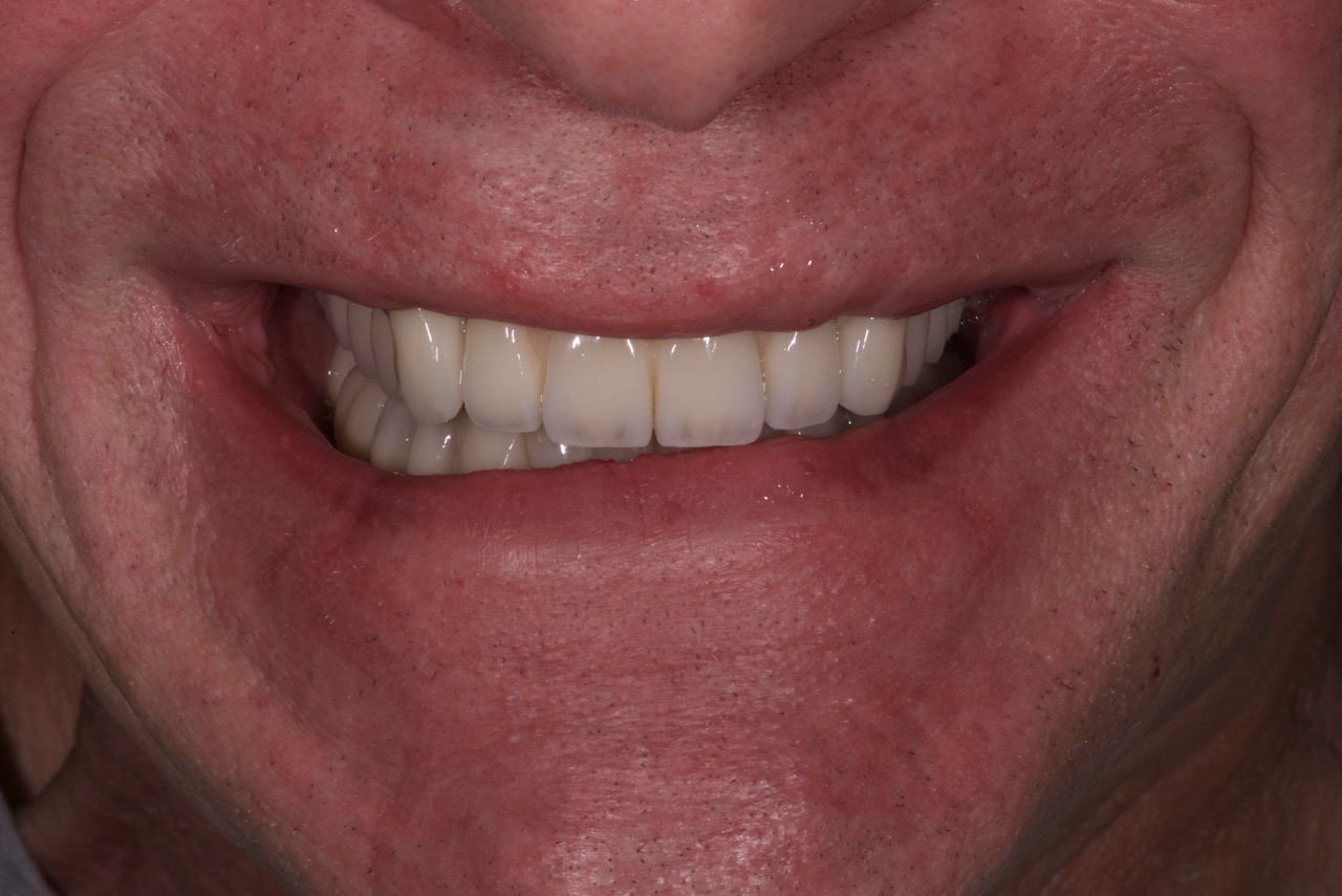 Après Implants, Couronnes, Bridges, Facettes