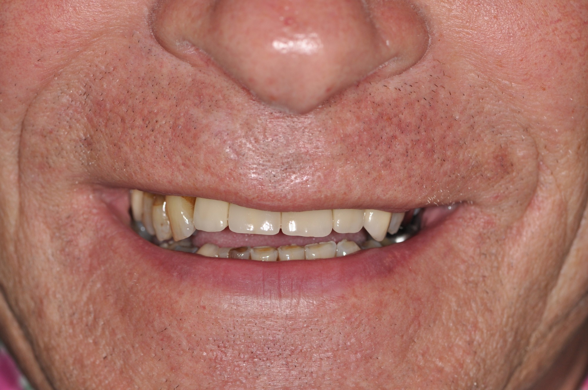 Reconstruction Dentaire Complète d'un homme de 60 ans au Cabinet Dentaire Maupassant