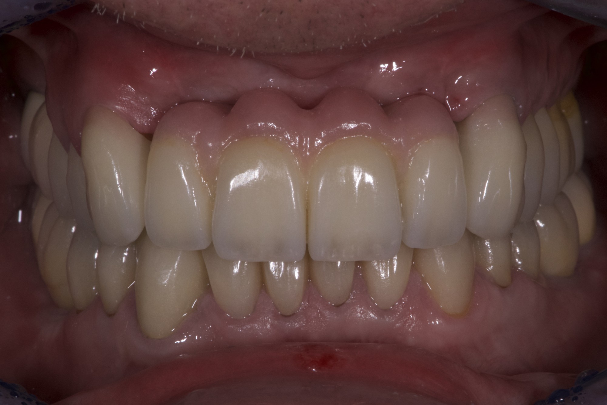 Après Implants, Couronnes, Bridges, Facettes