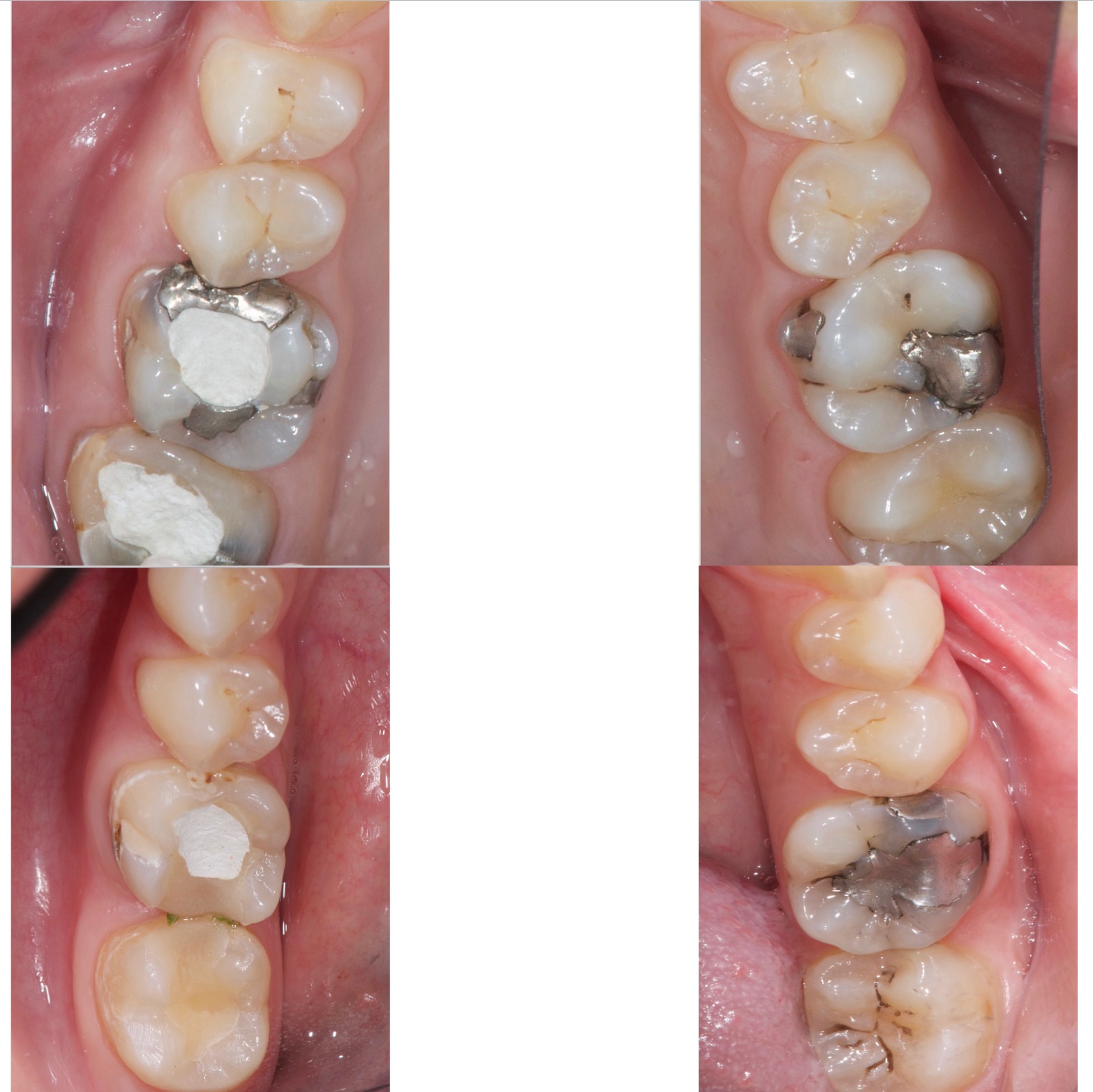 Vieux Amalgames et Caries