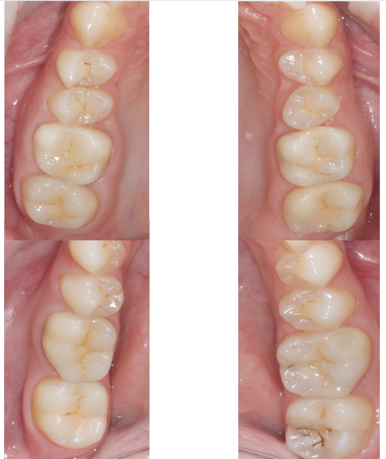 Couronnes et Onlays Céramiques
