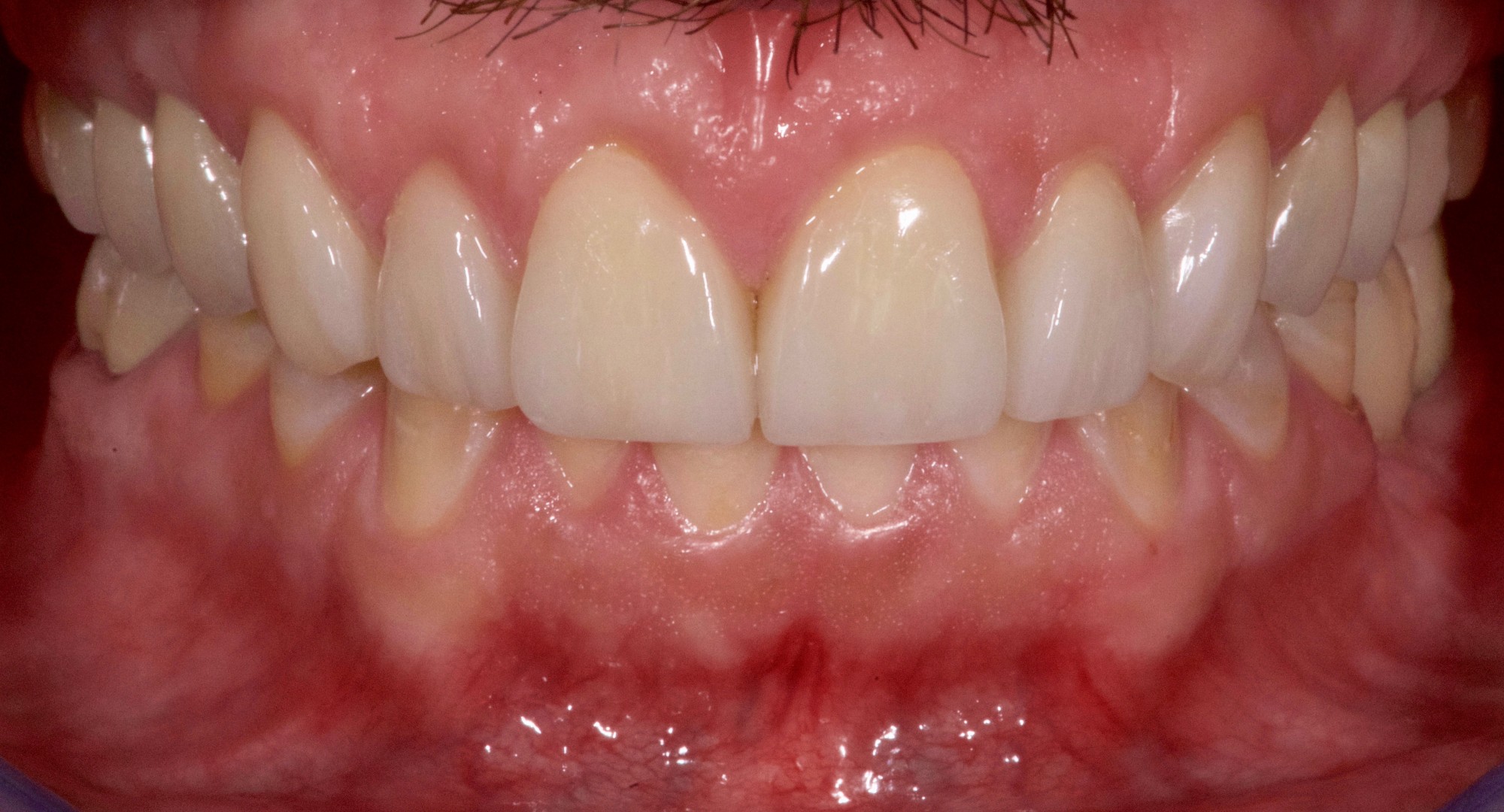 Facettes, Implants, Couronnes Tout Céramique