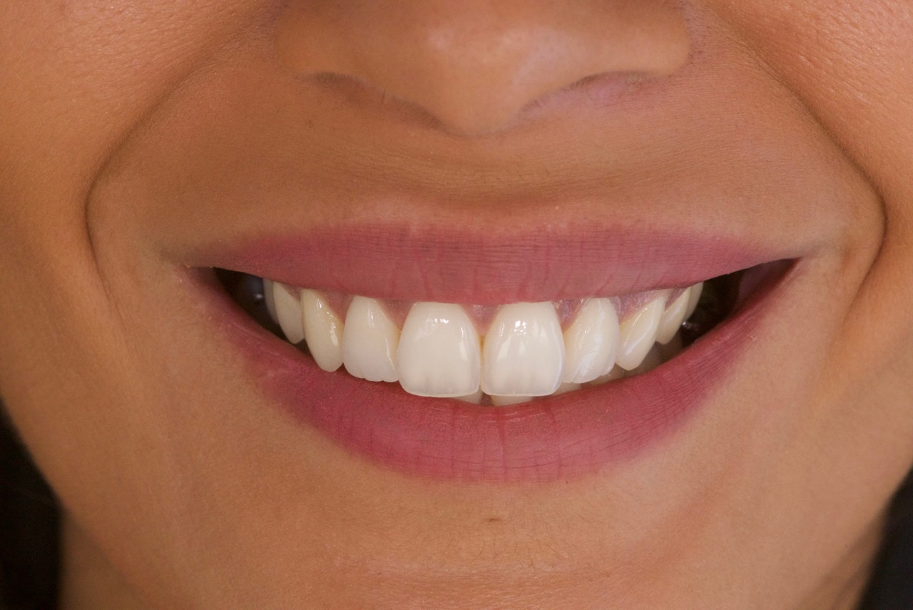 Blanchiment, Facettes, Composites