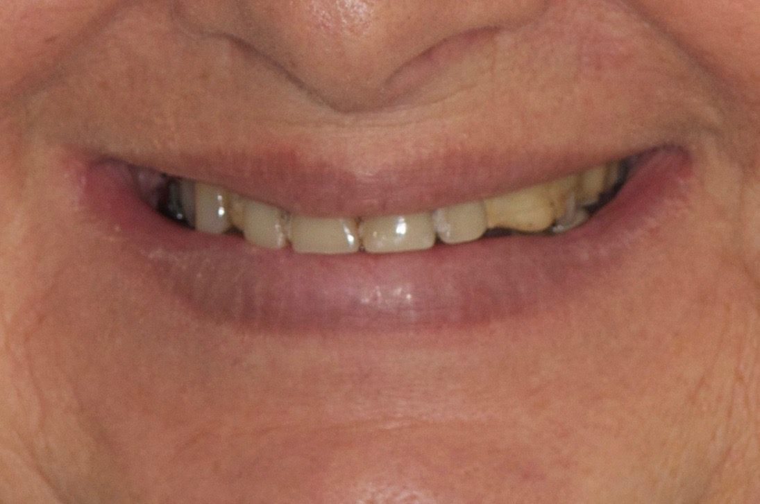 Sourire avant traitement femme 80 ans