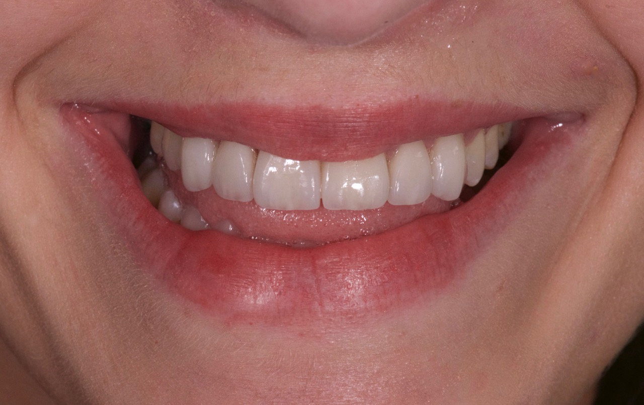 Sourire femme 30 ans après Blanchiment et Facettes