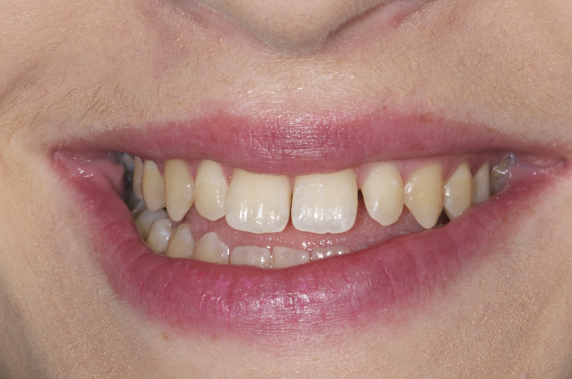 Sourire femme 30 ans avant