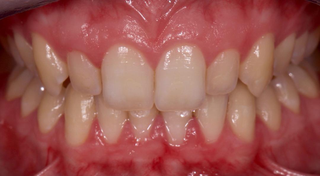 Dents jaunes Patiente 20 ans 13008