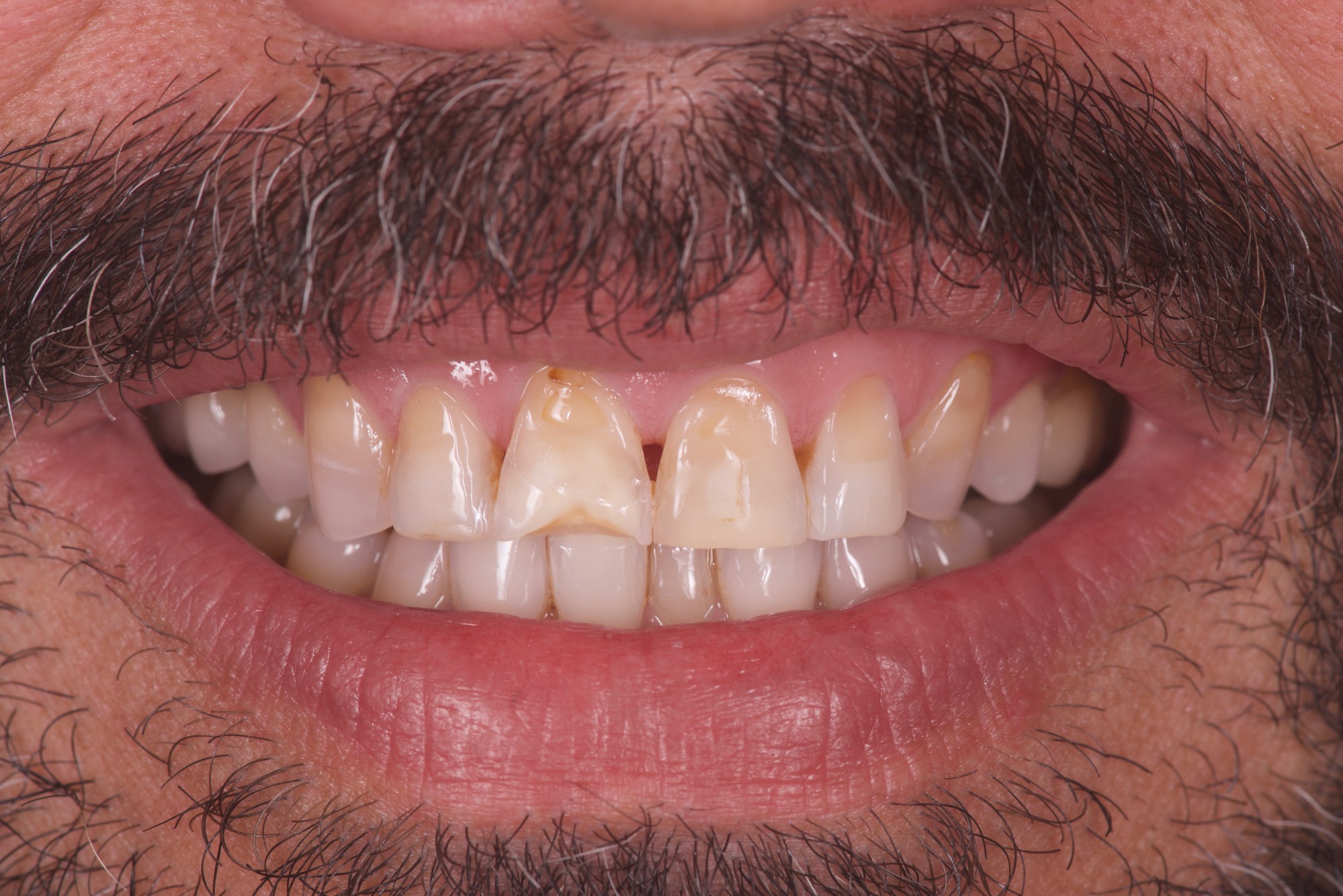 Sourire patient dents jauneset érosion