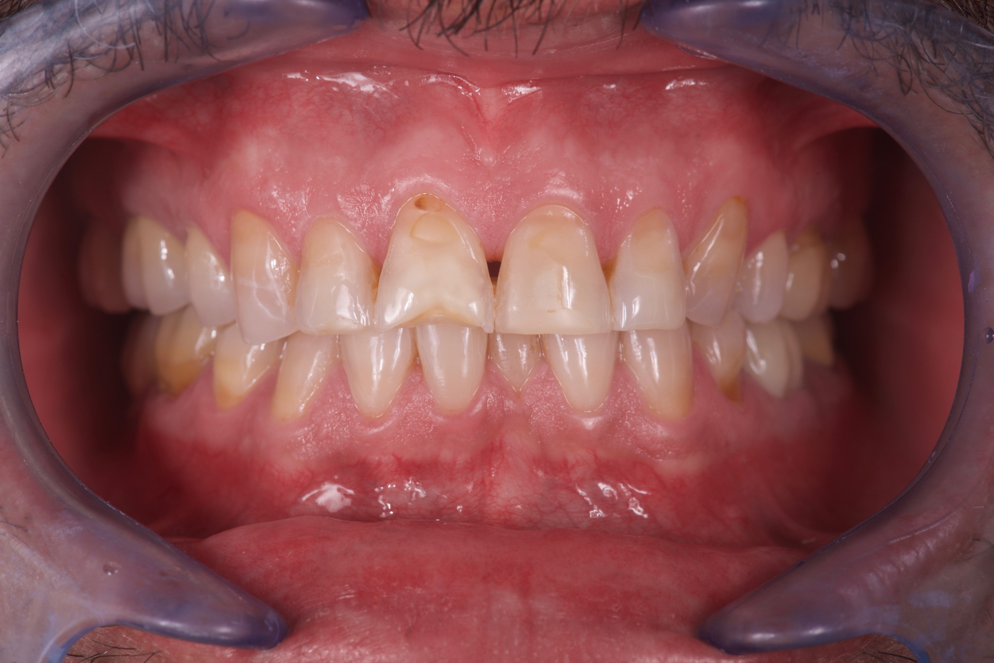 Je n'aime pas mes dents avant traitement par le Cabinet Dentaire Maupasant