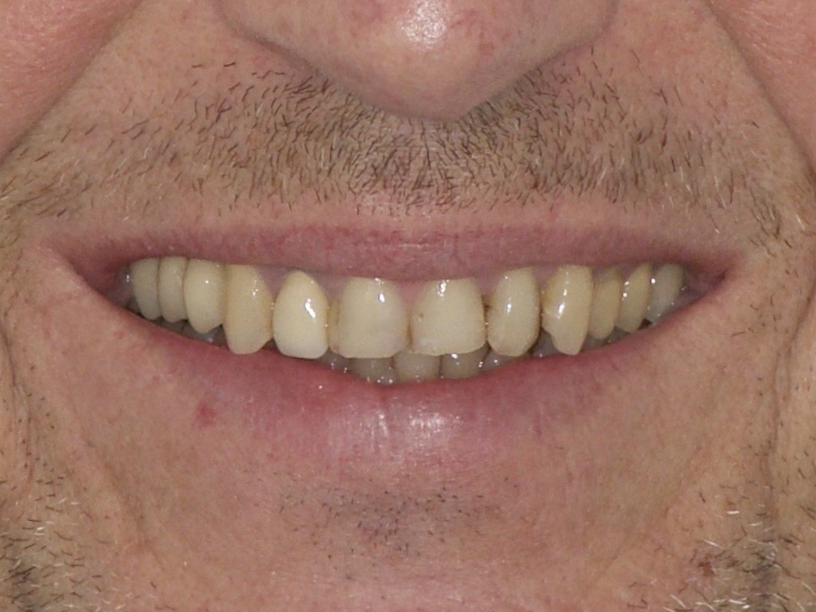 Mes dents lors de ma première consultation au Cabinet Dentaire Sainte Anne 13008