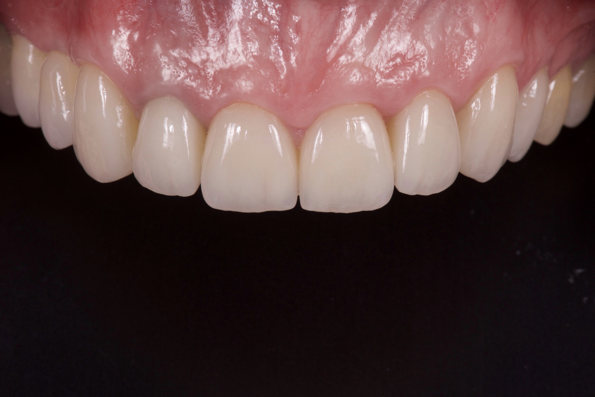 Facettes, couronnes et blanchiment dentiste 13008 Sainte Anne Marseille