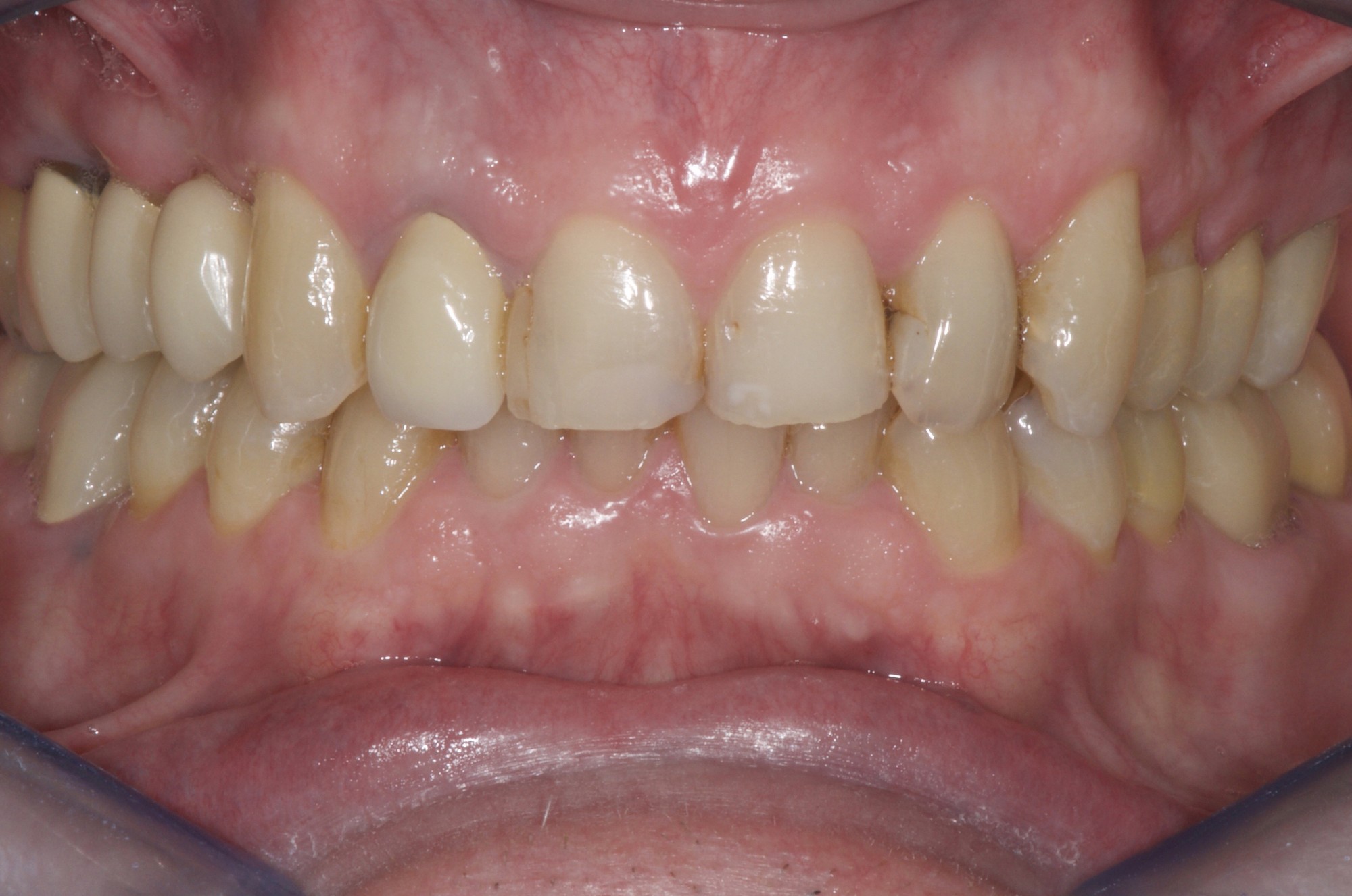 Blanchiment, Facettes et Couronnes Dentaires Céramiques de la dentition d'un homme de 55 ans au Cabinet Dentaire Maupassant