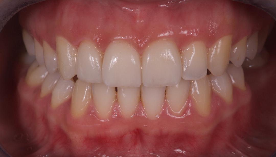 Mon nouveau sourire grâce aux Drs Sebban et Vartanyan (13009 Marseille)