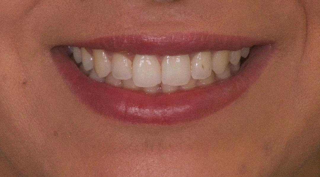 Je n’aime pas la couleur et la forme de mes dents