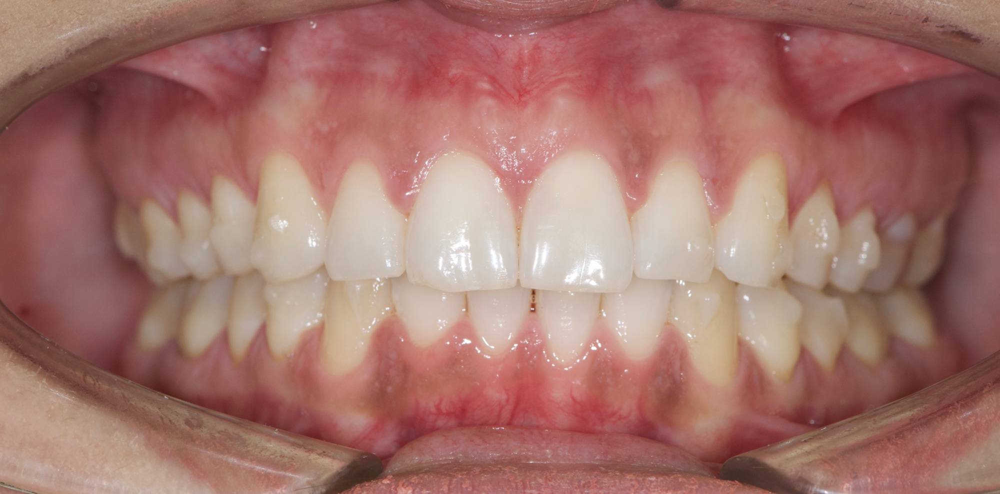 cas terminé , 8 mois de gouttière Invisalign