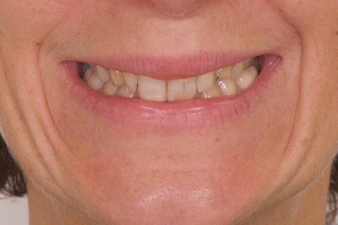 Dents Jaunes et dents de lait, Agénésie