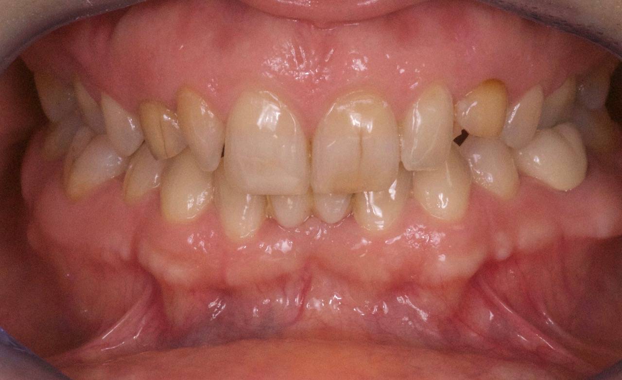 Dents jaunes et agénésie