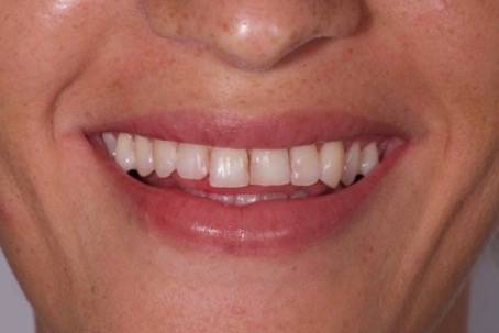 Dents jaunes, caries