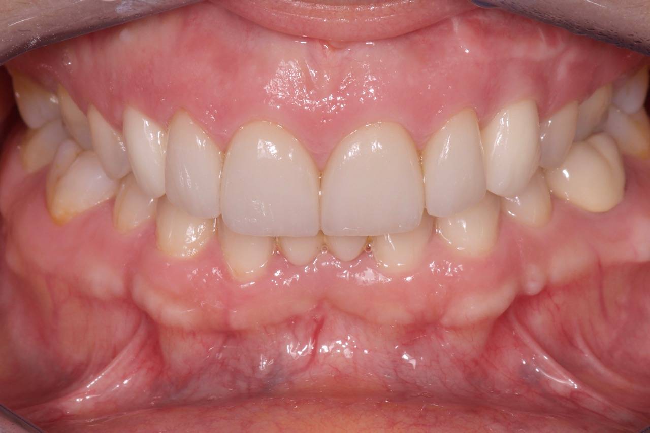 Facettes , Blanchiment, Implants Marseille 13009