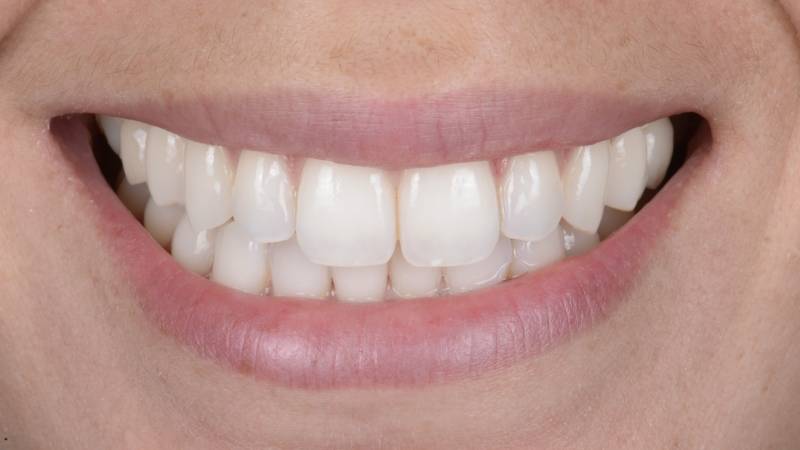 Sourire plus blanc après blanchiment dentaire professionnel