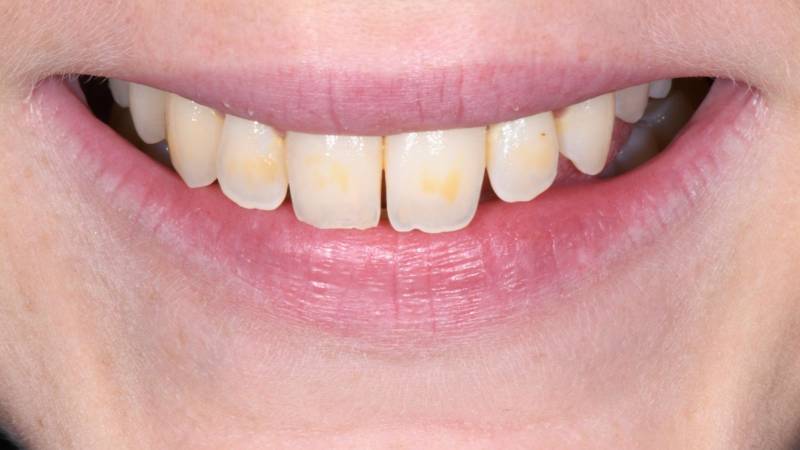 Je n'aime pas mes dents jaunes, je n'aime pas mon sourire