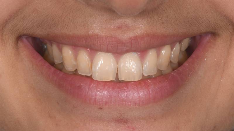 Dents jaunes Dents écartées et Taches sur les dents