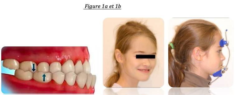 Mâchoire du haut trop reculée par rapport à celle du bas