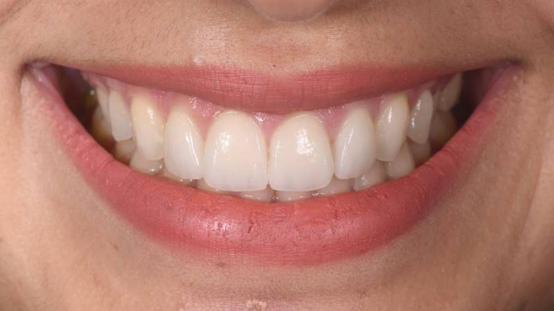 Sourire parfait Dents blanches Dents alignées Facettes céramiques