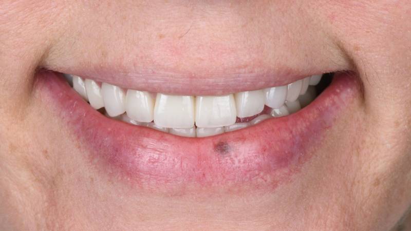 Nouveau sourire esthétique facettes orthodontie implants blanchiment jolie sourire dents alignées