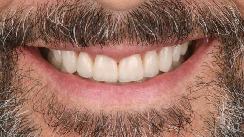 Facettes dentaire  implants dentaires sourire blanc dents alignées