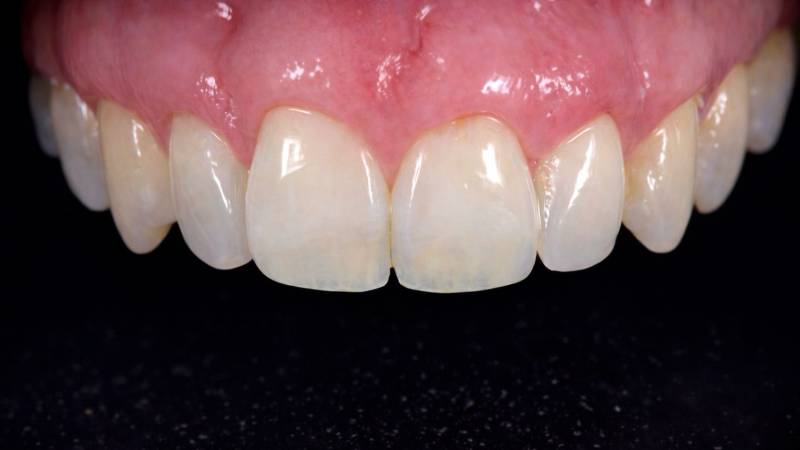 Greffe gingivale Marseille