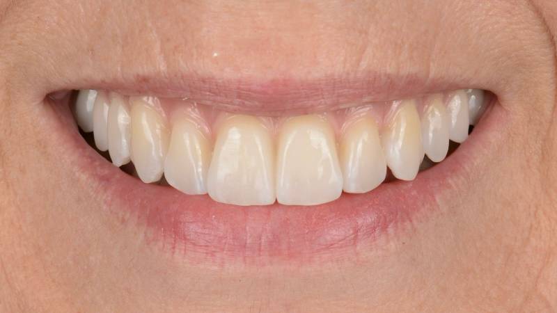 Sourire esthétique dents blanches dents alignées implants et bridge céramique marseille 13
