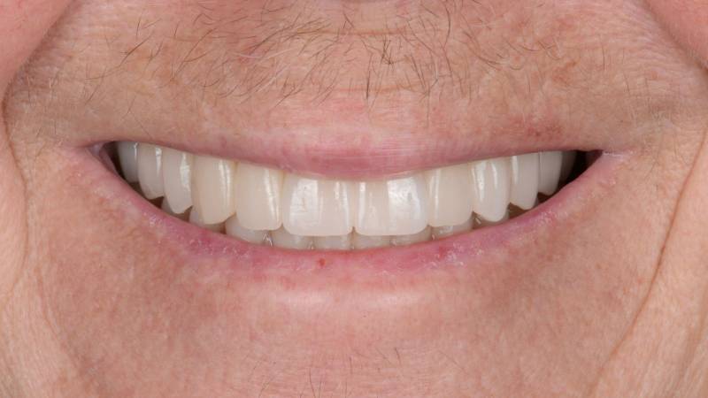 Implants multiples Bridge sur Implant Nouveau sourire