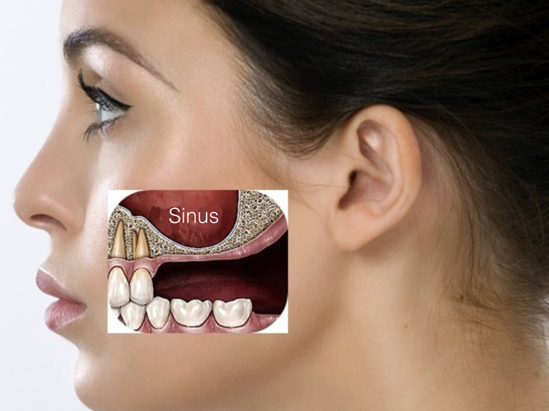 Sinus lift à Marseille