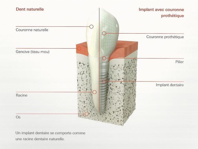 implant dentaire