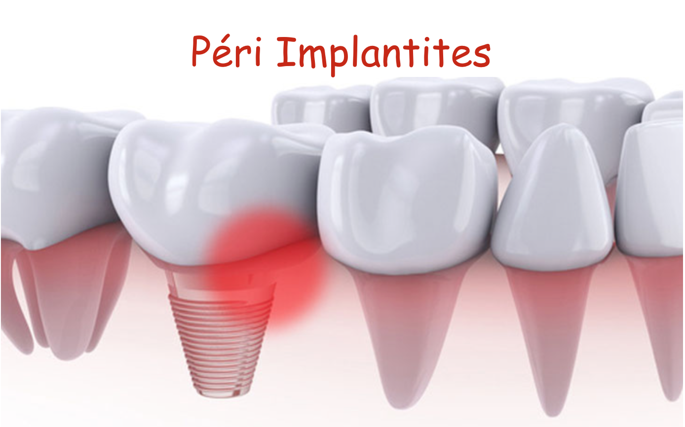 Implants dentaire qui saignent