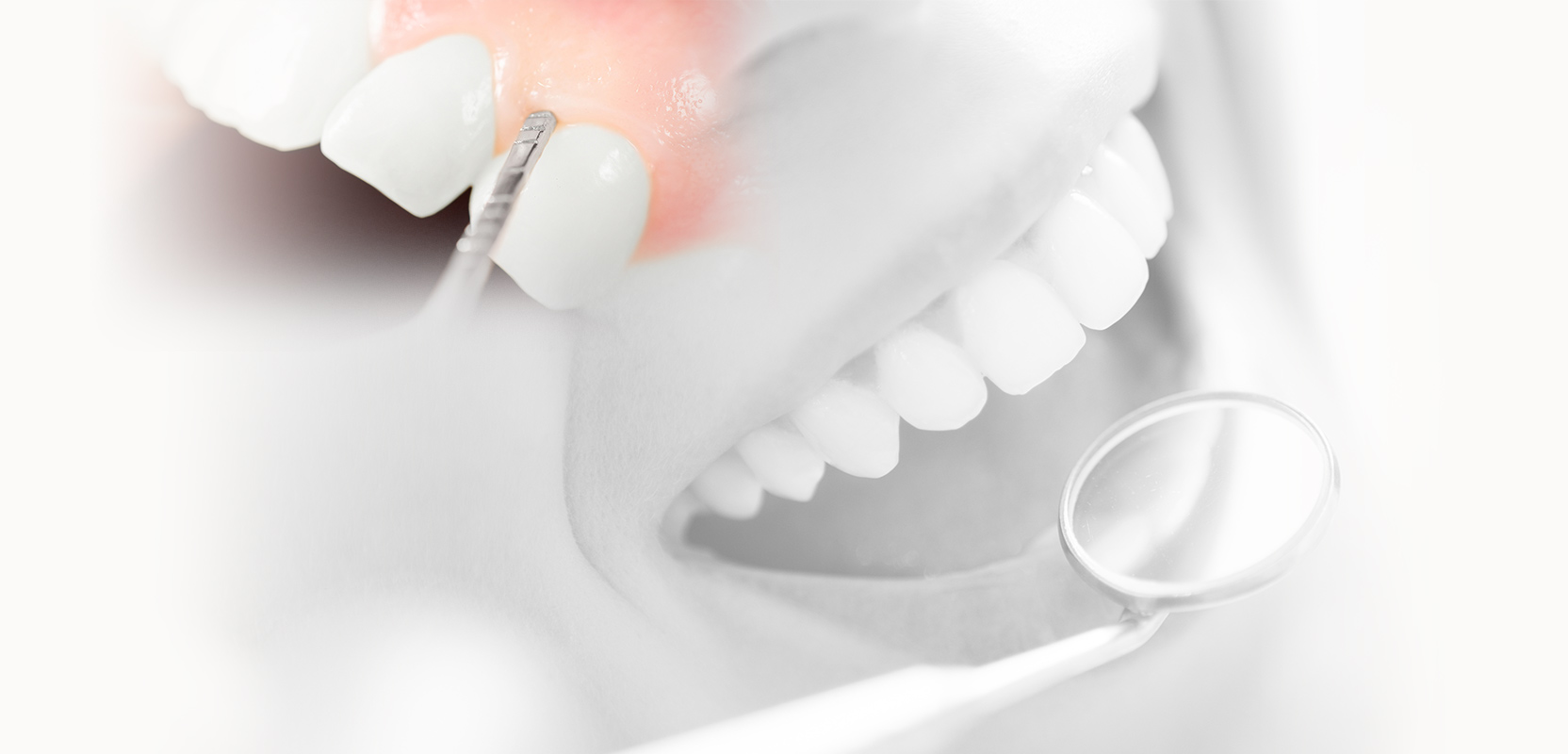 Notre zone d'activité pour ce service Tarif implants dentaires pour remplacer son dentier