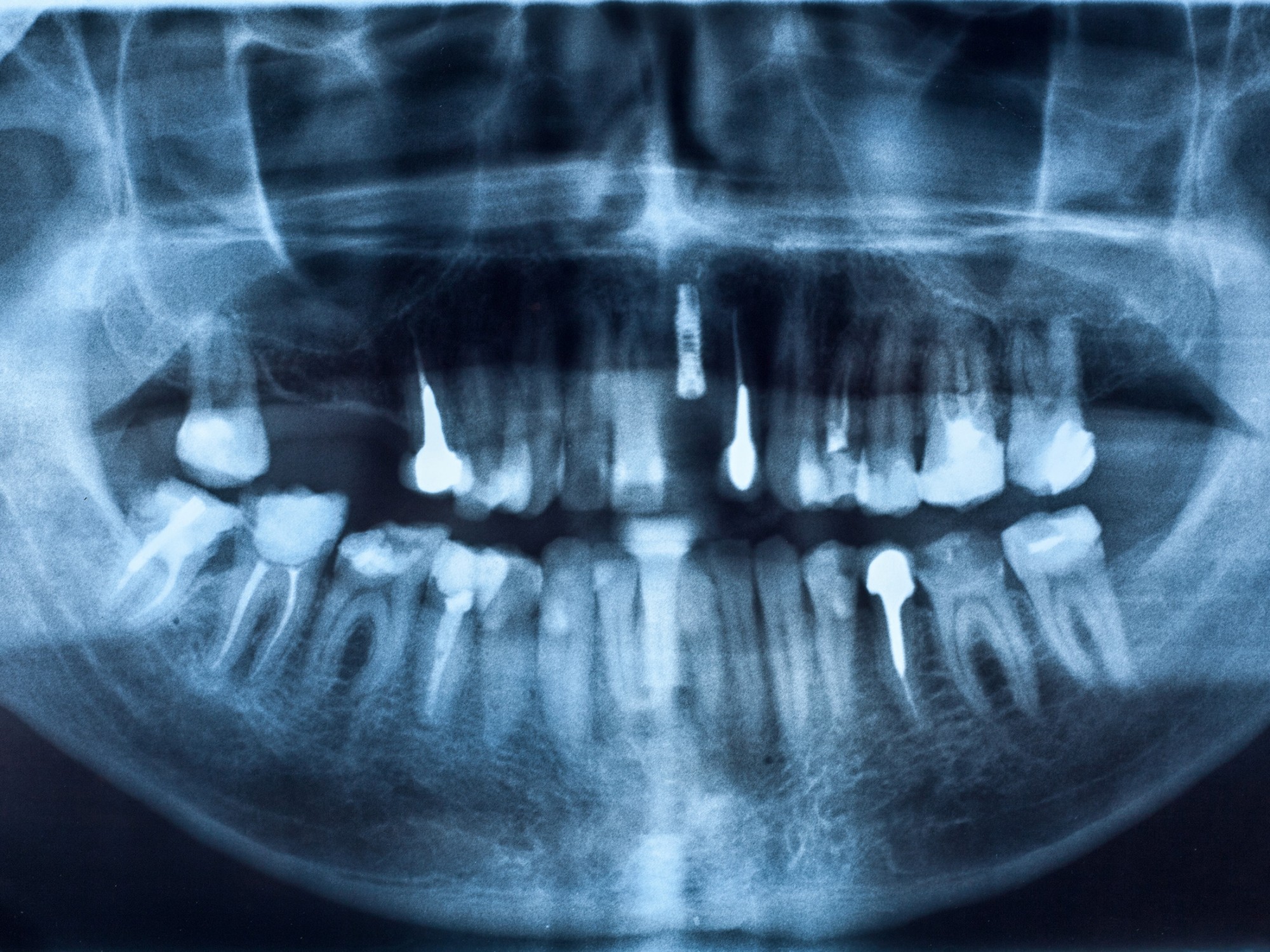 Témoignage après la pose d'implants à Marseille